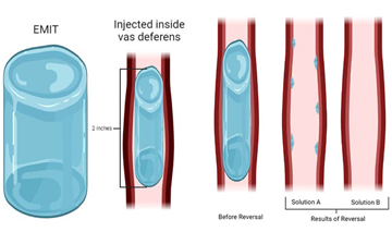 A series of two images including a diagram of a blue cylinder shown inside and outside of the vas deferens, and a diagram showing two versions of the vas deferens with only traces of the blue cylinder left.
