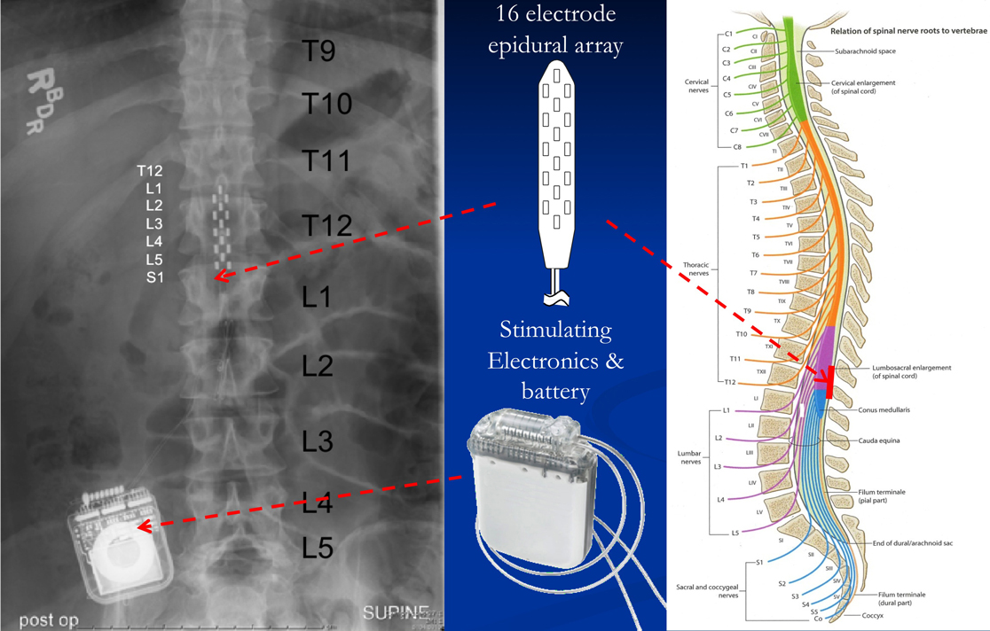 Reawakening Spinal Cord Circuits Shows Promise for the Paralyzed