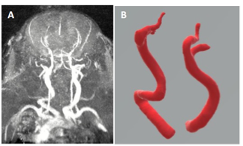 Image of an MRA and 3D rendering of brain arteries
