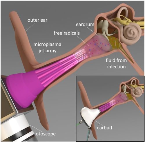Illustration of microplasma treatment being used to treat a middle ear infection