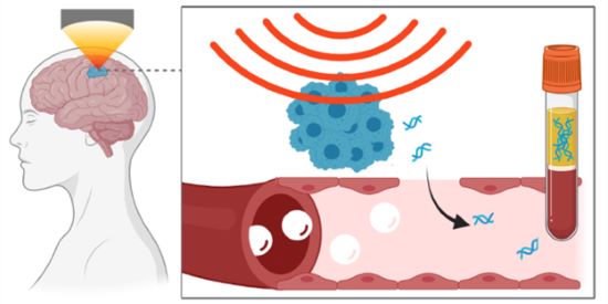 Illustration of sonobiopsy: focused ultrasound, directed at the brain tumor, helps to permeabilize the blood-brain barrier, allowing tumor DNA into the bloodstream to be collected and analyzed