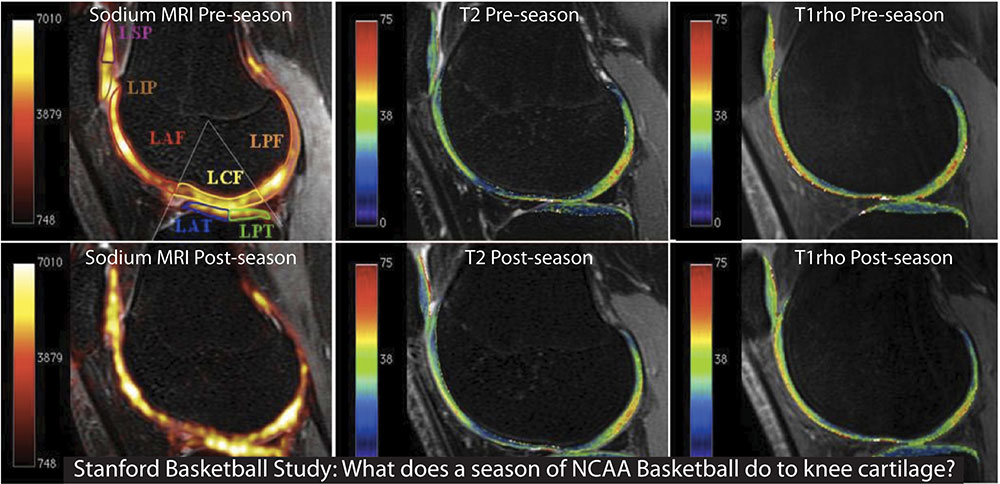 Tres imágenes de IRM de una rodilla antes de una temporada de baloncesto de la NCAA y tres imágenes post-temporada