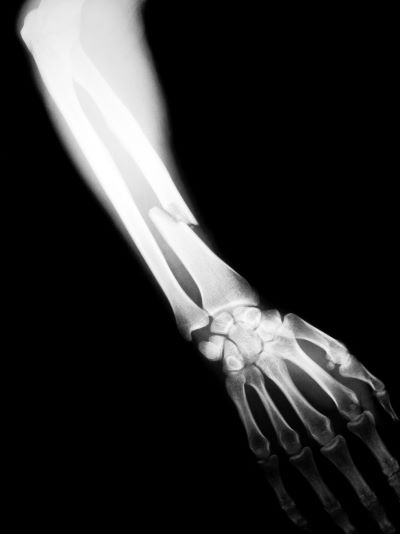 Radiografía de un brazo roto.