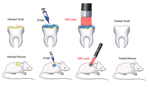 Two sets of graphics showing scenarios where nanoparticles and near infrared light are used to destroy biofilms in infected teeth and wounded skin. 