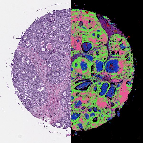 cancer biopsy showing digital and infrared enhanced samples
