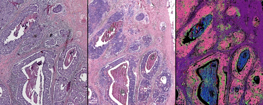 comparison of cancer pathology stains with digital stains of same tissue