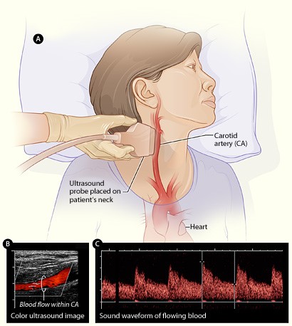 Illustration of a women getting an ultrasound of blood flow in her carotid arteries