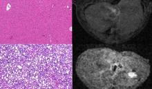Healthy and fibrotic liver tissue, as seen using H&E staining and a new MRI probe