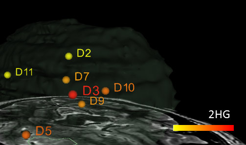 Mass spectrometry of 2-HG shows brain tumor borders