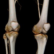 CT image of the knees