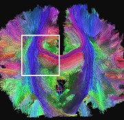 human brain scan using MRI/DTI