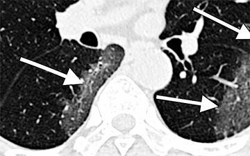 MRI of chest with arrows pointing to points on the lungs