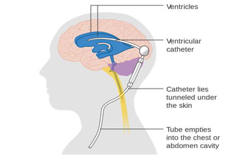 CephalloPump designed to treat low pressure hydrocephalus