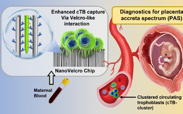Graphic illustrating the non-invasive test for placenta accreta spectrum (PAS) disorder. 