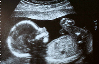 Ultrasound of a fetus