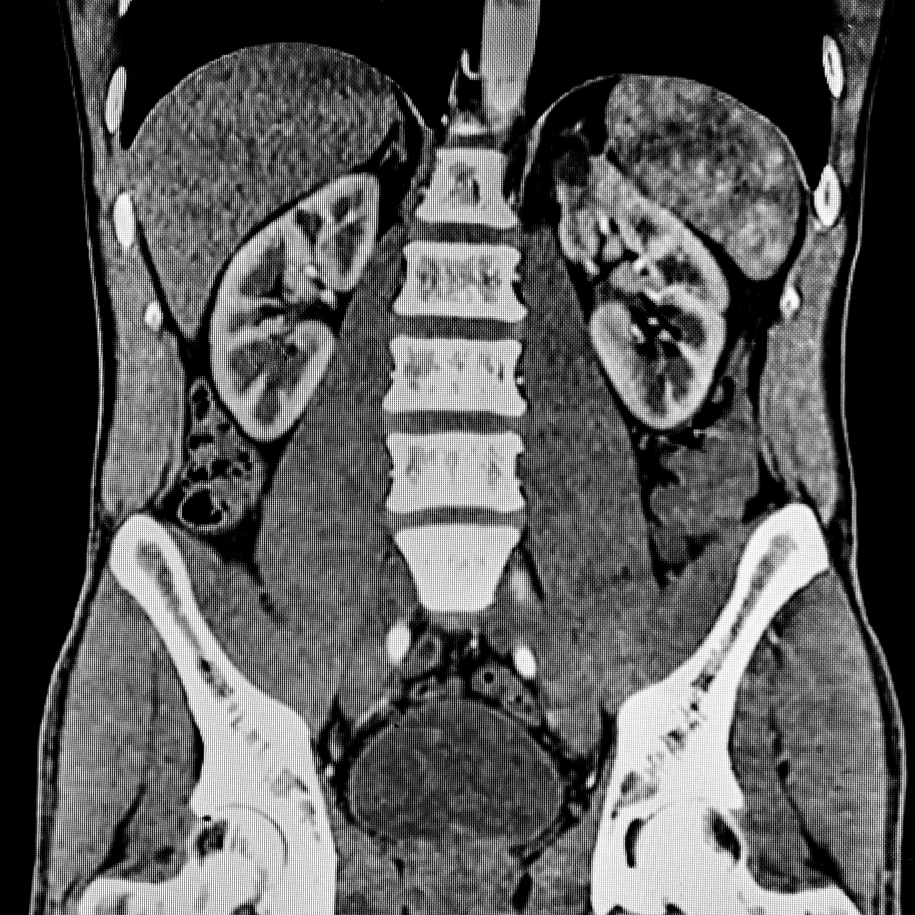 CT scan of the abdomen