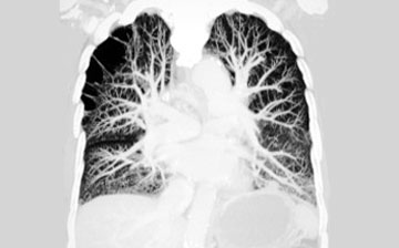 Heart and lung scan