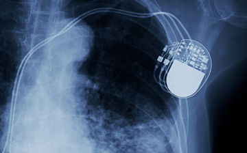 An x-ray of a chest showing a medical device