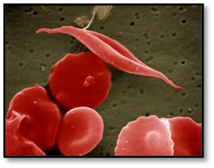 sickle red blood cell 