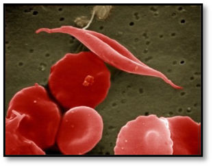 sickle red blood cell