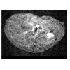 Black and white image of liver fibrosis