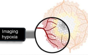 Artist’s rendition of decreasing oxygen levels moving from the periphery to the center of a solid tumor.