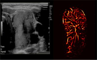 Ultrasound images depict a thyroid tumor. Conventional ultrasound produced the image on the left, which does not capture the details of the tumor's microvasculature. The image on the right, produced by high-definition microvasculature imaging, show the vessels in higher detail.
