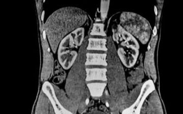 CT of the abdomen