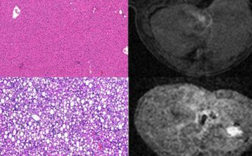 Liver fibrosis visualized using cell staining and MRI