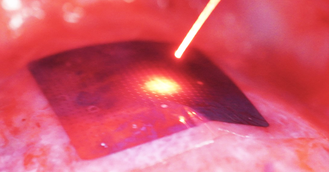 Wireless, light-powered pacemaker shines brightly in animal study Wireless, light-powered pacemaker shines brightly in animal study