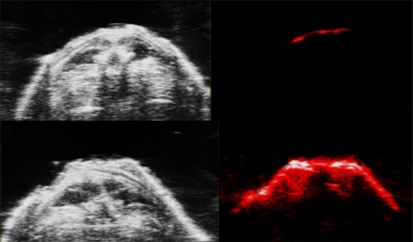 Four medical images of bacterial infections in animals. The two on the left are ultrasound while the two on the right are photoacoustic. The image on the bottom right shows signals stemming from nanoparticles embedded within the infection. 