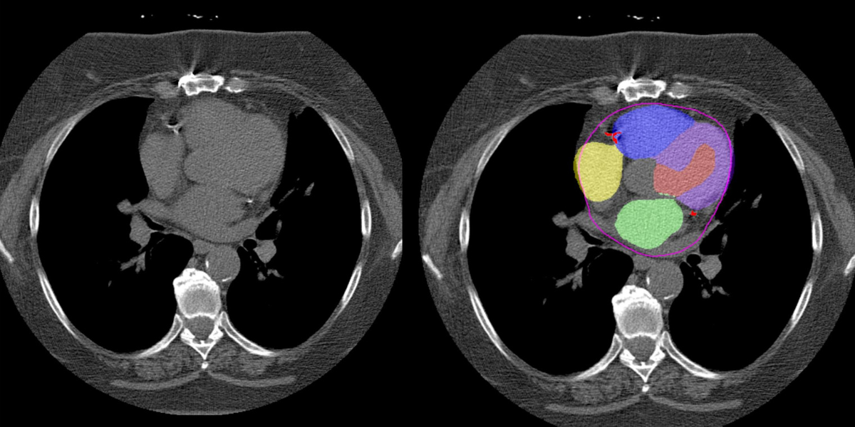 Using AI to reuse routine CT scans Using AI to reuse routine CT scans