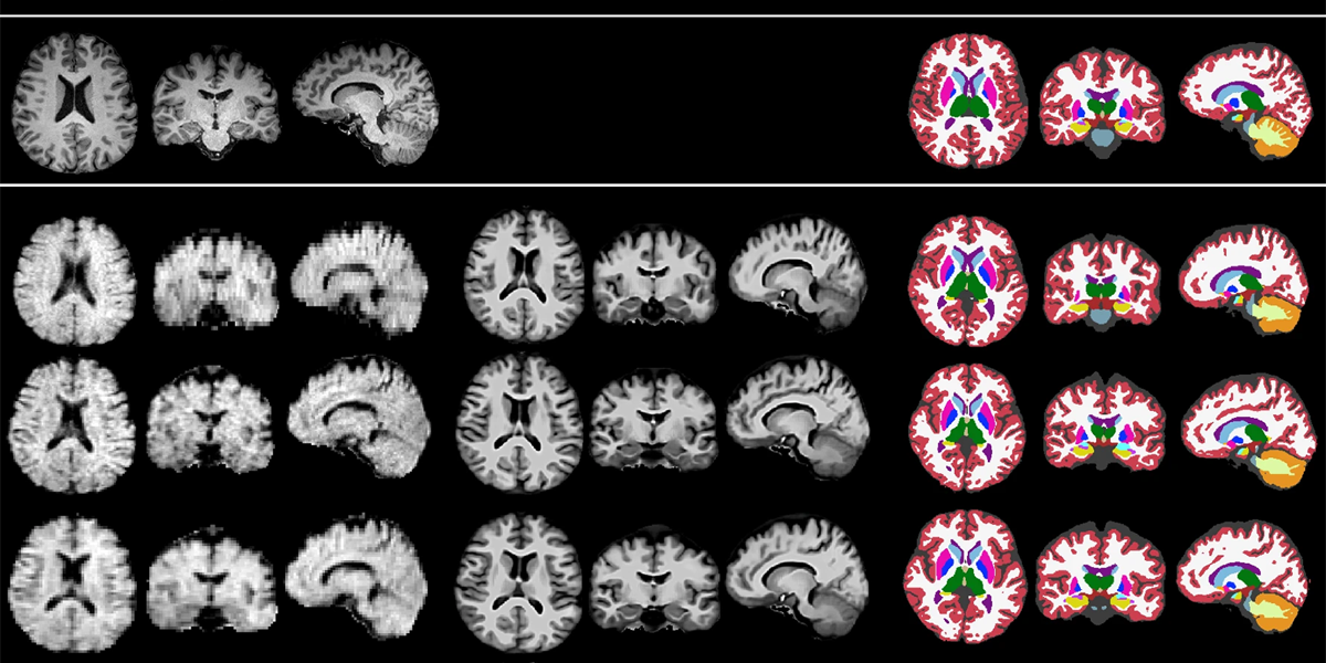 AI-Enhanced Wearable MRI Proves Feasible Brain Imaging for Dementia AI-Enhanced Wearable MRI Proves Feasible Brain Imaging for Dementia