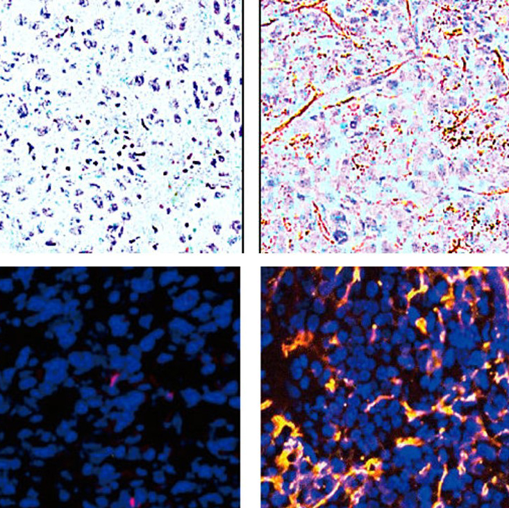 prostate tissue stain reveals EDB-FN in high grade tumors prostate tissue stain reveals EDB-FN in high grade tumors