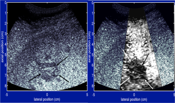 Metastatic melanoma is a type of liver tumor that does not show up well in conventional ultrasound (left), but because it is stiffer than the surrounding tissue, it is more clearly displayed in the ARFI image on the right as a darker mass. This is an image of a liver with metastatic melanoma.