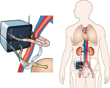 Esquemática de colocação de rim artificial implantável