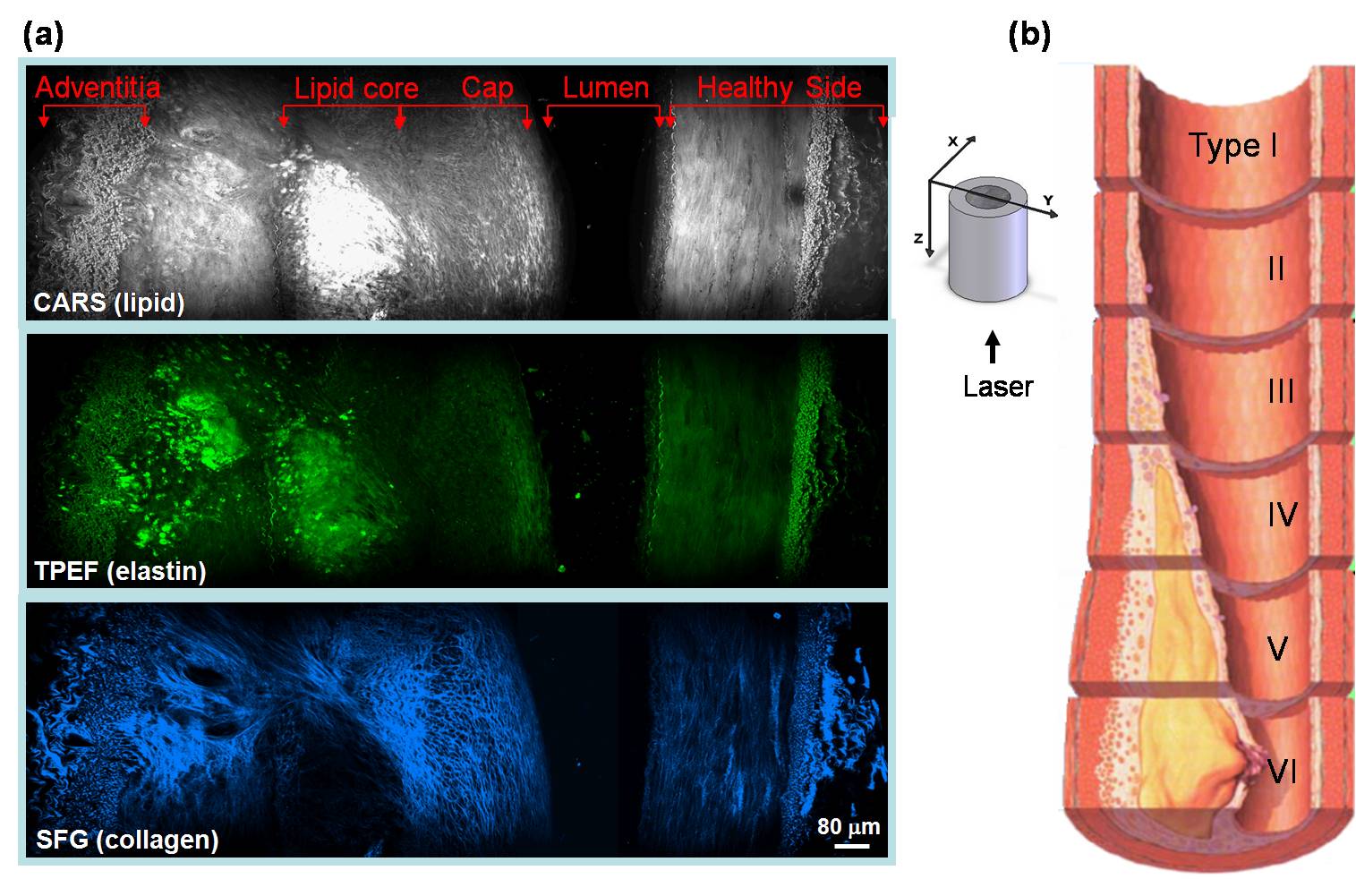 (a) Imagen del corte transversal de una placa aterosclerótica en una arteria mediante técnicas CARS, TPEF y SFG en la misma plataforma. La placa se enriquece en lípidos (gris) y autofloresencia (verde), pero carece de fibrillas de colágeno (azul). (b) Características de diferentes tipos de placa definidas por el Comité de Lesiones de la American Heart Association. Imagen de Han-Wei Wang y Ji-Xin Cheng.