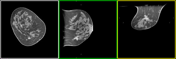 Un escáner de seno TC dedicado puede tomar imágenes de lesiones cancerosas de seno con la misma precisión que la mamografía y hacerlo con mucho menos molestias. Las lesiones cancerosas, realzadas usando tintes de imagen, son claramente visibles con estas tomografías TC.