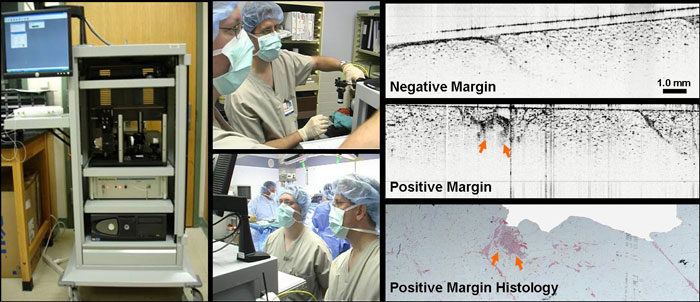 Los cirujanos están utilizando tomografía de coherencia óptica para evaluar tejido inmediatamente después de ser removido, en este caso del seno. La imagen superior no muestra señal de cáncer; la imagen del centro muestra células cancerosas restantes (en las flechas rojas) y coincide con la imagen inferior, una diapositiva de patología tradicional.