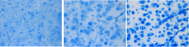 Las células madre mesenquimales encapsuladas en los hidrogeles de ácido hialurónico se cultivan durante 14 días bajo condiciones que promueven la formación de cartílago. La densidad del hidrogel es la más baja en el panel izquierdo y mayor en el panel de la derecha. El aumento de la densidad del hidrogel causa una distribución desigual de un componente del cartílago llamado proteoglicano (anillos azules alrededor de las células), lo que resulta en cartílago de calidad inferior.