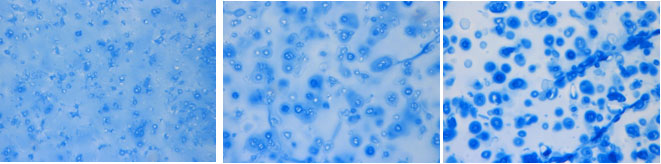 Mesenchymal stem cells encapsulated in hyaluronic acid hydrogels are grown for 14 days under conditions that promote cartilage formation. The hydrogel density is lowest in the left panel and highest in the right panel. Increased hydrogel density causes uneven distribution of a cartilage component called proteoglycan (blue rings around cells), which results in inferior quality cartilage. Las células madre mesenquimales encapsuladas en los hidrogeles de ácido hialurónico se cultivan durante 14 días bajo condiciones que promueven la formación de cartílago. La densidad del hidrogel es la más baja en el panel izquierdo y mayor en el panel de la derecha. El aumento de la densidad del hidrogel causa una distribución desigual de un componente del cartílago llamado proteoglicano (anillos azules alrededor de las células), lo que resulta en cartílago de calidad inferior.