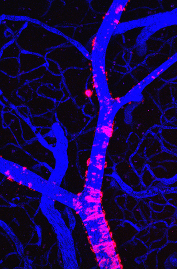 Esta imagen muestra un vaso sanguíneo afectado con angiopatía amiloide cerebro-vascular (CAA) en un modelo de ratón con depósitos amiloides que se encuentran en la enfermedad de Alzheimer. Las imágenes longitudinales de segmentos individuales de vasos sanguíneos, cargados de angiopatía CAA, permiten detectar la depuración de la angiopatía CAA después de un tratamiento con anticuerpo anti-Aβ (Prada et al., J. Neurosci., 2007). Se realizaron angiografías fluorescentes, con el compuesto “Texas red dextran”, para identificar marcadores fiduciarios (seudocolor azul). Se identifican depósitos Aβ vasculares y parenquimales por medio de fluorescencia de metoxilo-XO4 administrado sistémicamente (seudocolor rojo). La imagen se obtuvo con microscopía multifotónica, por Claudia Prada.