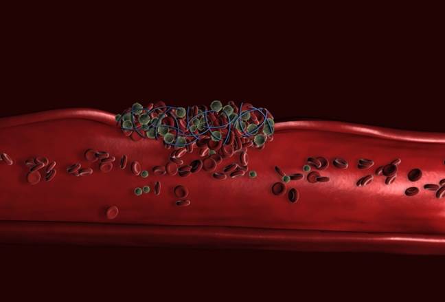 Illustration of platelets, red blood cells, and fibrin fibers combining to form a clot to stop bleeding