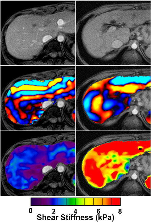 Elastografía por resonancia magnética puede detectar fibrosis hepática. Línea superior: Imágenes convencionales de resonancia magnética de dos pacientes diferentes fallan en mostrar la presencia de fibrosis hepática. Línea central: Ondas acústicas son generadas en el abdomen con un dispositivo de control e imágenes de las ondas tomadas con una técnica especial de IRM capaz de obtener imágenes de ellas. Línea inferior: Las imágenes de las ondas son procesadas para generar imágenes cuantitativas mostrando la dureza del tejido (elasogramas). El paciente a la derecha tiene una dureza de hígado notablemente elevada, con un promedio de 7 kilopascales, indicando la presencia de fibrosis hepática moderadamente avanzada. El paciente a la izquierda tiene una dureza hepática normal de aproximadamente 2 kilopascales. Imagen cortesía de Richard Ehman.