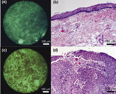 Imágenes in vivo utilizando el microendoscopio de fibra óptica en alta resolución revelan algunas de las mismas características de tejido que una histología convencional de una muestra de biopsia. Imágenes de la mucosa oral sana muestran núcleos pequeños uniformemente espaciados (a, microendoscopio; b, histología convencional). Imágenes del cáncer oral muestran núcleos grandes y con formas y espaciamiento variables (c, microendoscopio; d, histología convencional).