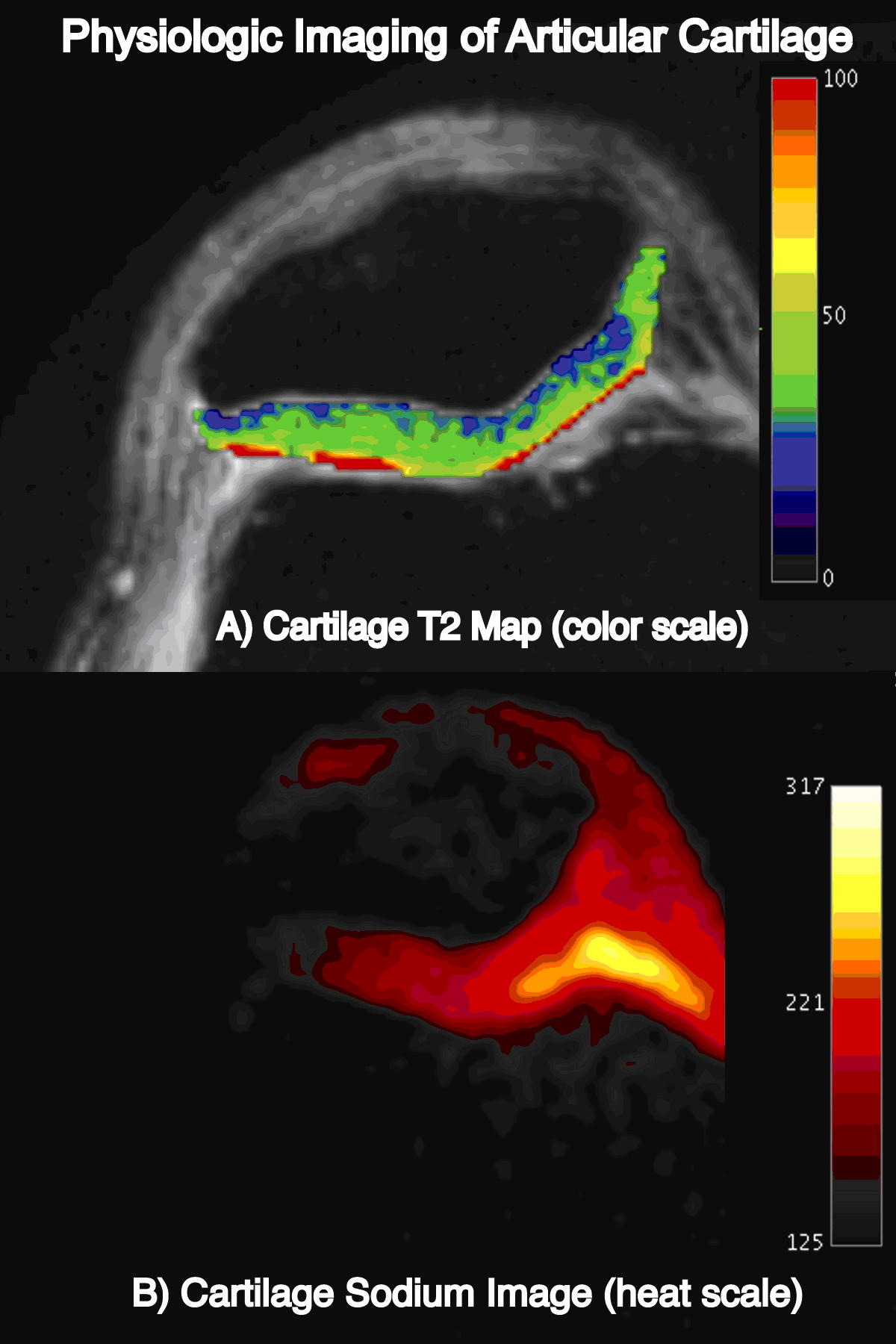Las imágenes por resonancia magnética (MRI) tienen la capacidad de brindar información, estructural y fisiológica, que es más sensible a cambios degenerativos tempranos en el cartílago. Un examen rápido de MRI para osteoartritis (OA) podría incluir: A) Mapeo T2 para calcular la cantidad de colágeno en el cartílago, y B) imagen médica de sodio para calcular el contenido de glicosaminoglicano, un componente importante del tejido conectivo. Estas medidas fisiológicas deben ser más sensibles a cambios tempranos de OA que la sola información estructural. Cortesía del Dr. Garry Gold, Universidad de Stanford.