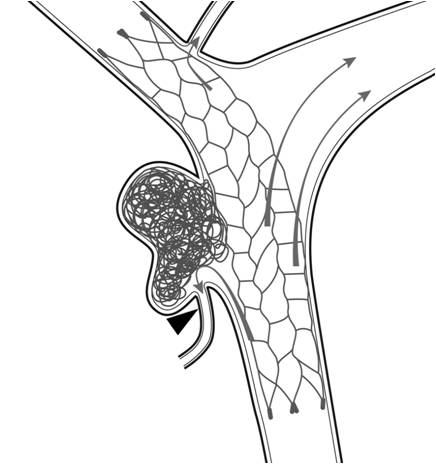 This schematic of a wide-neck brain aneurysm depicts a retrievable stent designed to help hold a coil mass in the aneurysm. Arrows indicate the direction of blood flow. Arrowhead shows a small brain artery that stays open as a result of the coils' deployment. This schematic of a wide-neck brain aneurysm depicts a retrievable stent designed to help hold a coil mass in the aneurysm. Arrows indicate the direction of blood flow. Arrowhead shows a small brain artery that stays open as a result of the coils' deployment.