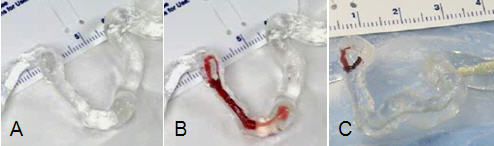 Un modelo de la arteria media del cerebro muestra (A) una arteria sin coágulo de sangre y (B) la arteria bloqueada por un coágulo. En (C), se muestra la arteria modelo 15 minutos después de insertar el cable para derrames; se ha eliminado la mayor parte de la masa del coágulo y restaurado el flujo mínimo de sangre. La investigación actual se enfoca en disminuir el tiempo requerido para retirar un coágulo de sangre y restaurar por completo el flujo sanguíneo.