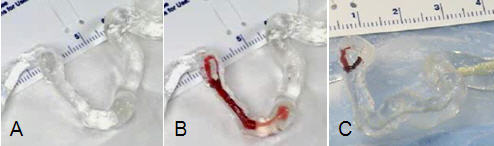 A model of the middle cerebral artery shows (A) an artery without a blood clot and (B) the artery blocked by a clot. In (C), the model artery is shown 15 minutes after inserting a stroke wire; the majority of the clot mass has been obliterated and minimal blood flow restored. Current research is focused on decreasing the time required to remove a blood clot and fully restore blood flow. A model of the middle cerebral artery shows (A) an artery without a blood clot and (B) the artery blocked by a clot. In (C), the model artery is shown 15 minutes after inserting a stroke wire; the majority of the clot mass has been obliterated and minimal blood flow restored. Current research is focused on decreasing the time required to remove a blood clot and fully restore blood flow.