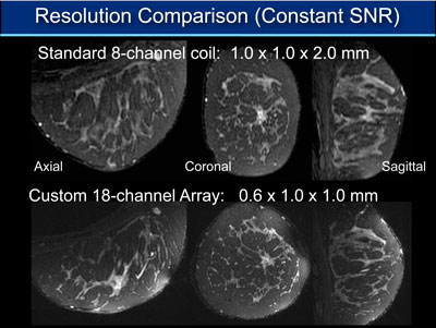 La comparación de las imágenes en 3D utilizando una bobina estándar del seno (arriba) y la bobina personalizada Stanford del seno con tiempos de escaneo similares (abajo) en un voluntario sano. La serie de 18 canales de pequeñas bobinas permite obtener imágenes mucho más nítidas y también ofrece una visión más clara del seno en tres direcciones perpendiculares. Las imágenes son cortesía de la Dra. Catherine Moran de la Universidad de Stanford.